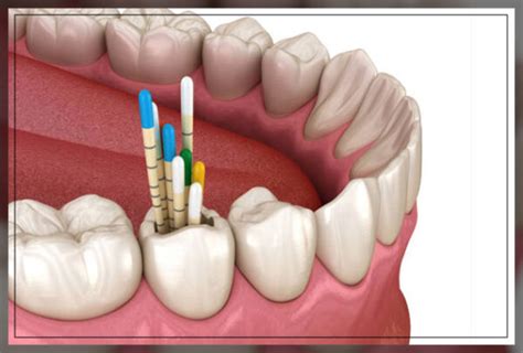  Gutta-Percha: ¿Revolucionará este material natural la industria de las prótesis dentales?